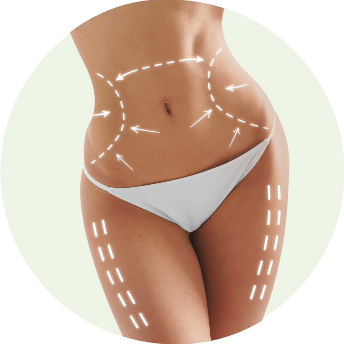 Liposuction